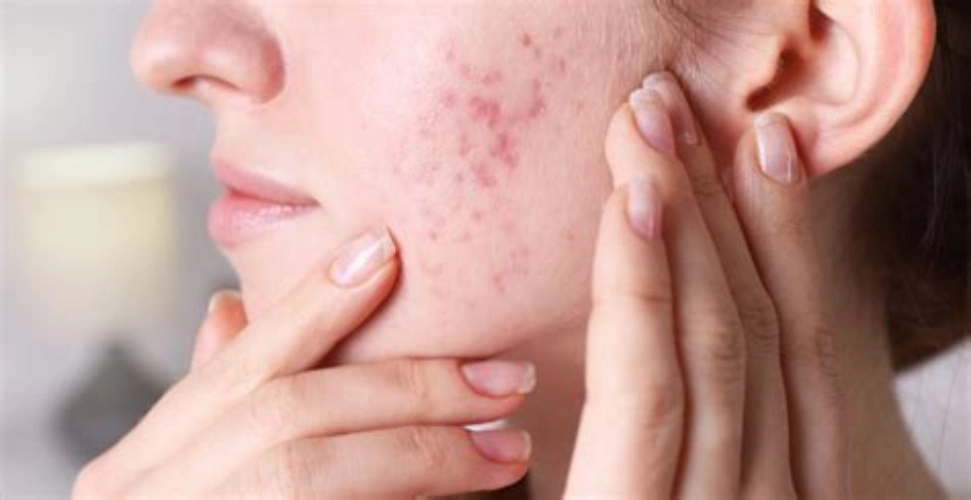 آیا مکمل باعث جوش صورت میشود ؟